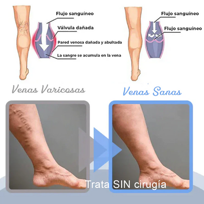 1+1 GRATIS | Spray Anti-Varices™ -Chumita Shop.